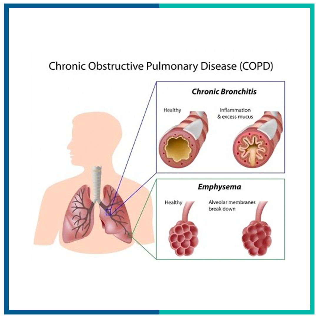 چگونه به بیمار COPD کمک کنیم؟